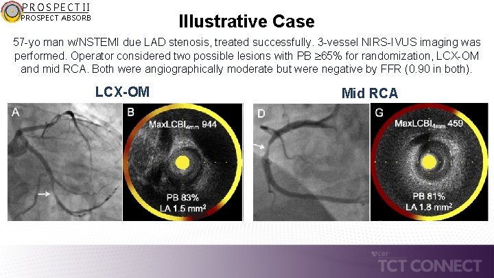 PROSPECT II Illustrative Case PROSPECT ABSORB 57 -yo man w/NSTEMI due LAD stenosis, treated