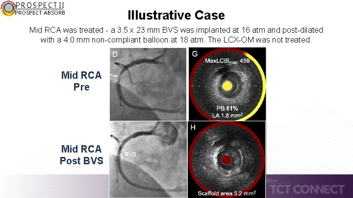 PROSPECT II PROSPECT ABSORB Illustrative Case Mid RCA was treated - a 3. 5