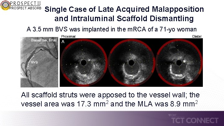 PROSPECT II PROSPECT ABSORB Single Case of Late Acquired Malapposition and Intraluminal Scaffold Dismantling
