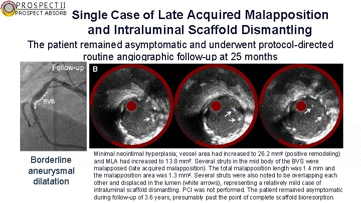 PROSPECT II PROSPECT ABSORB Single Case of Late Acquired Malapposition and Intraluminal Scaffold Dismantling