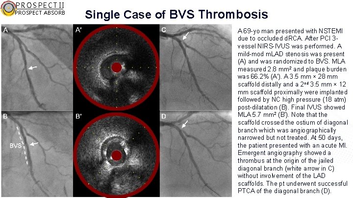 PROSPECT II PROSPECT ABSORB Single Case of BVS Thrombosis A 69 -yo man presented