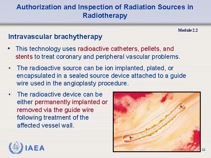 Authorization and Inspection of Radiation Sources in Radiotherapy Module 2. 2 Intravascular brachytherapy •