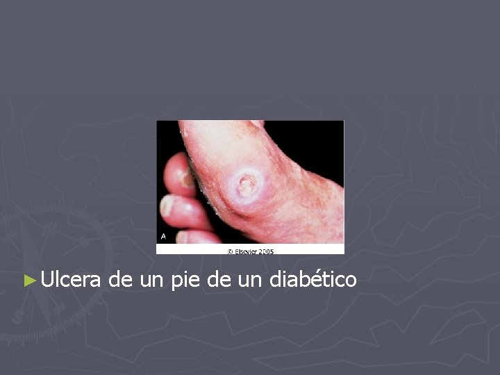 ► Ulcera de un pie de un diabético 