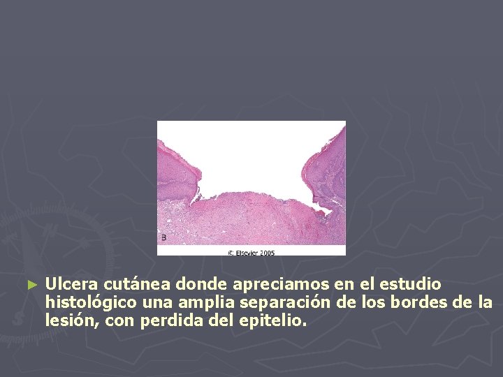 ► Ulcera cutánea donde apreciamos en el estudio histológico una amplia separación de los