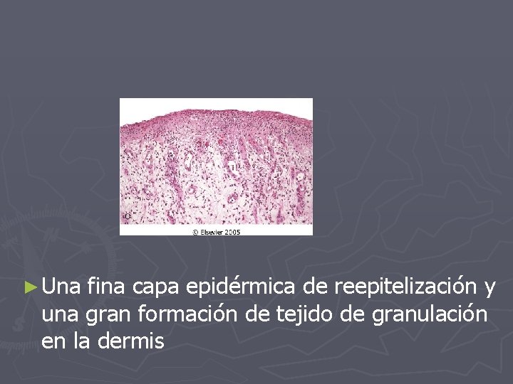 ► Una fina capa epidérmica de reepitelización y una gran formación de tejido de