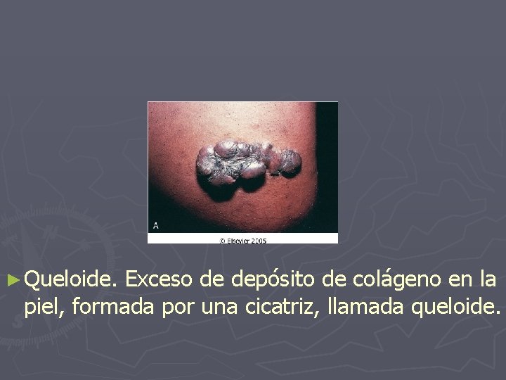► Queloide. Exceso de depósito de colágeno en la piel, formada por una cicatriz,