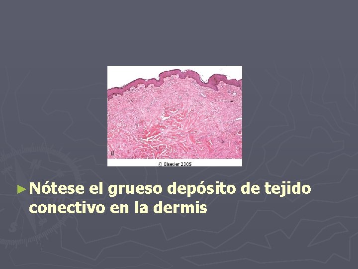 ► Nótese el grueso depósito de tejido conectivo en la dermis 