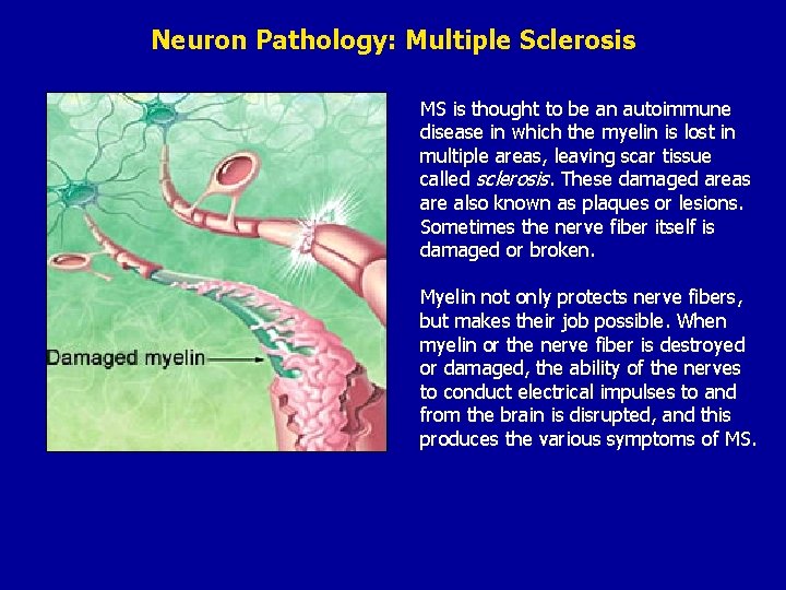 Neuron Pathology: Multiple Sclerosis MS is thought to be an autoimmune disease in which