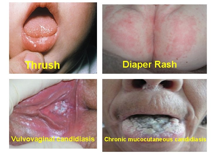 Thrush Vulvovaginal candidiasis Diaper Rash Chronic mucocutaneous candidiasis 