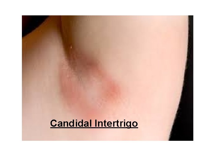 Candidal Intertrigo 