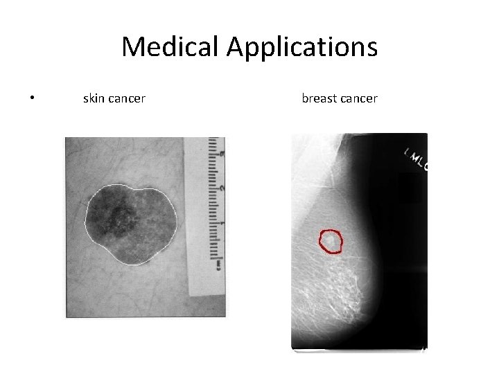 Medical Applications • skin cancer breast cancer 