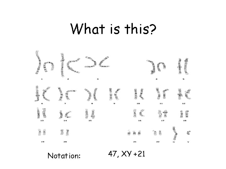 What is this? Notation: 47, XY +21 What is this? Notation: 47, XY +21