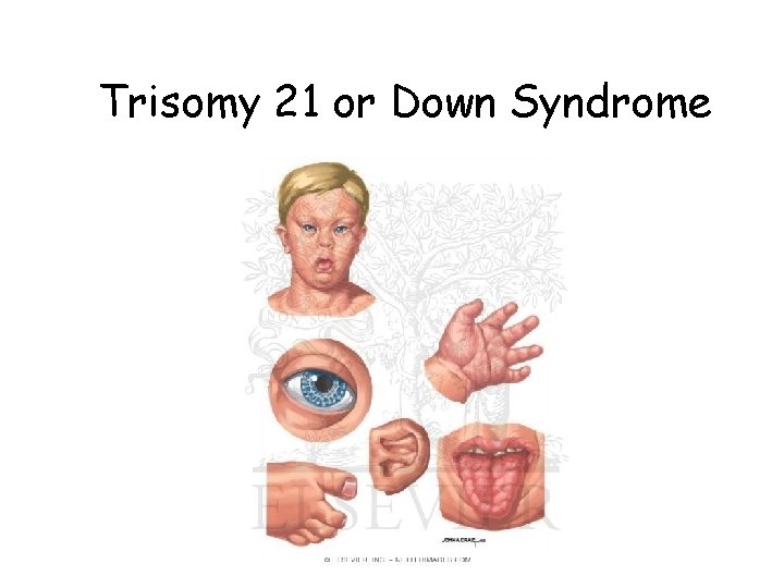 Trisomy 21 or Down Syndrome Trisomy 21 or Down Syndrome