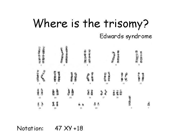 Where is the trisomy? Edwards syndrome Notation: 47 XY +18 Where is the trisomy? Edwards syndrome Notation: 47 XY +18