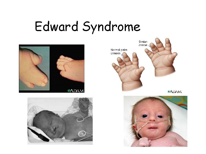 Edward Syndrome Edward Syndrome