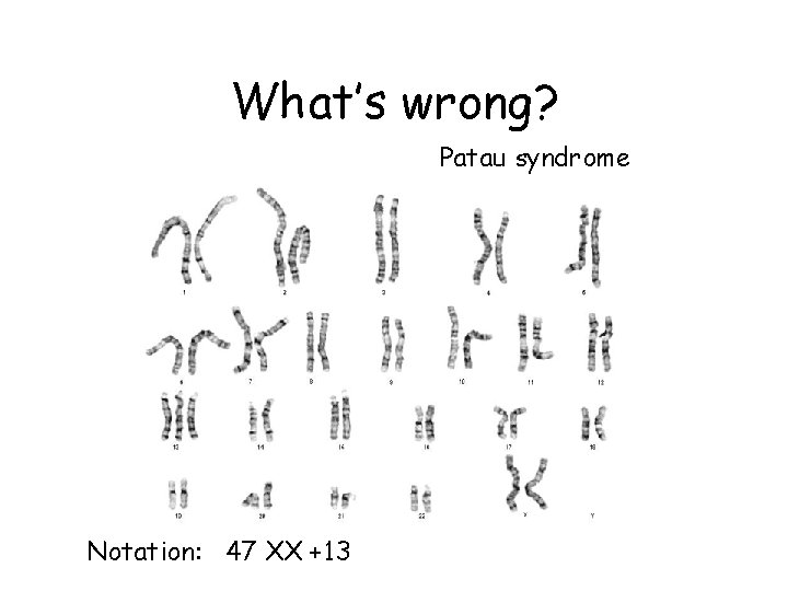 What’s wrong? Patau syndrome Notation: 47 XX +13 What’s wrong? Patau syndrome Notation: 47 XX +13