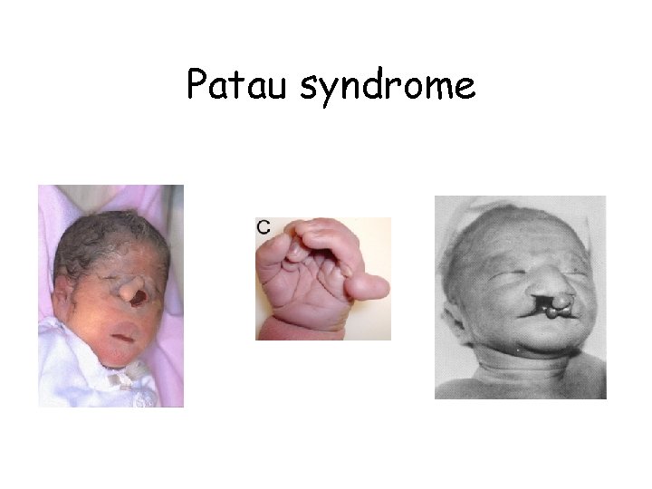 Patau syndrome Patau syndrome