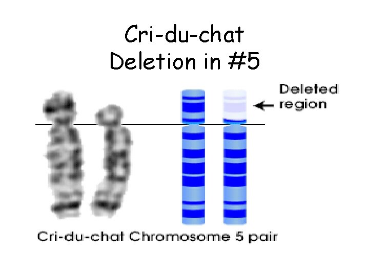 Cri-du-chat Deletion in #5 Cri-du-chat Deletion in #5
