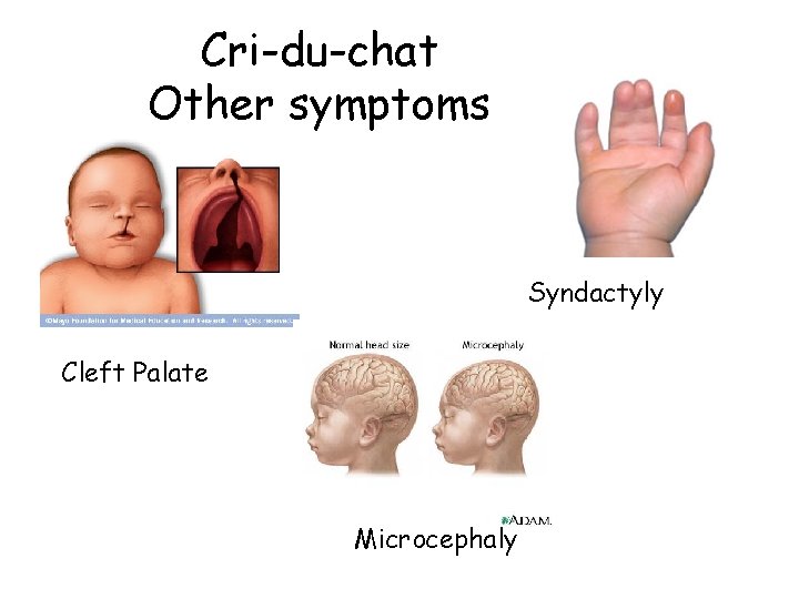 Cri-du-chat Other symptoms Syndactyly Cleft Palate Microcephaly Cri-du-chat Other symptoms Syndactyly Cleft Palate Microcephaly