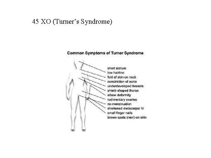 45 XO (Turner’s Syndrome) 45 XO (Turner’s Syndrome)