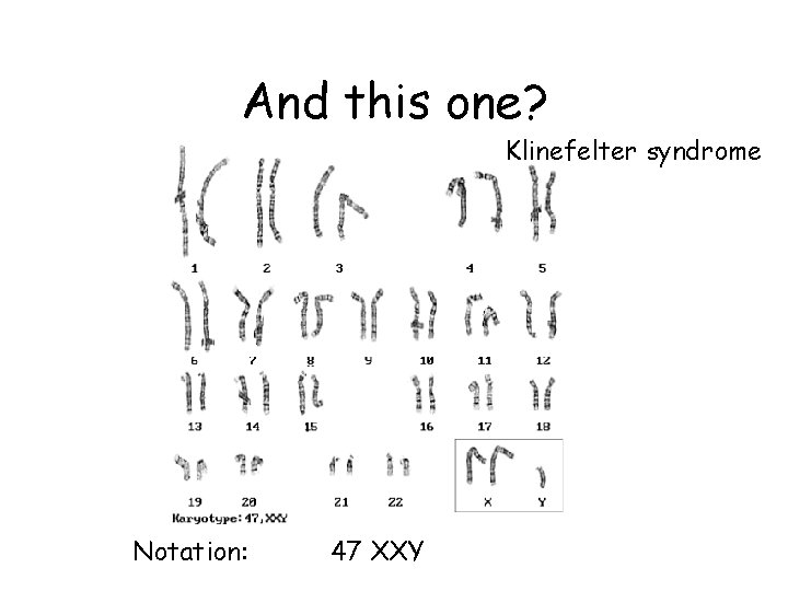 And this one? Klinefelter syndrome Notation: 47 XXY And this one? Klinefelter syndrome Notation: 47 XXY