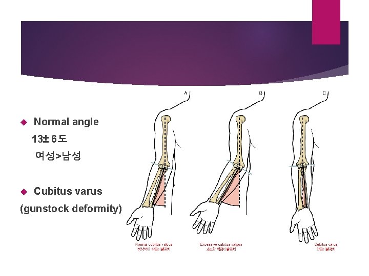  Normal angle 13± 6도 여성>남성 Cubitus varus (gunstock deformity) 