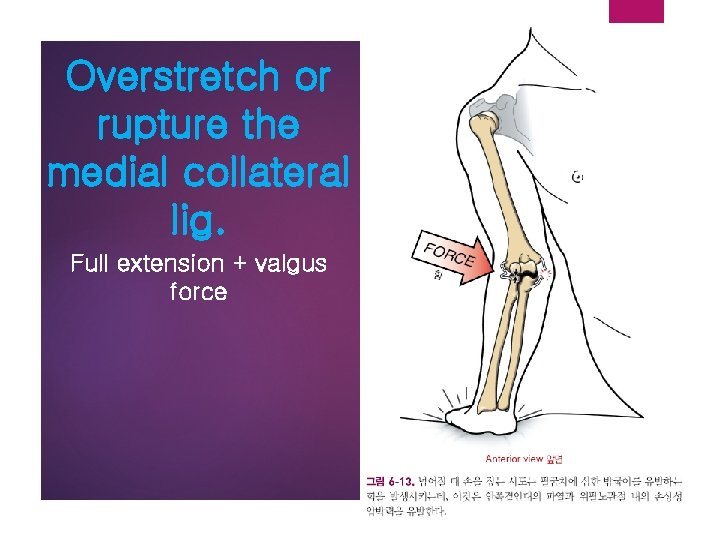 Overstretch or rupture the medial collateral lig. Full extension + valgus force 