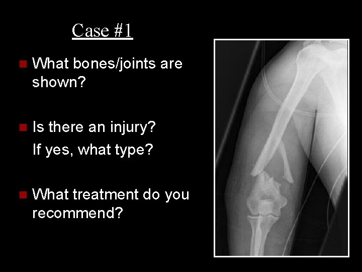 Case #1 n What bones/joints are shown? n Is there an injury? If yes,