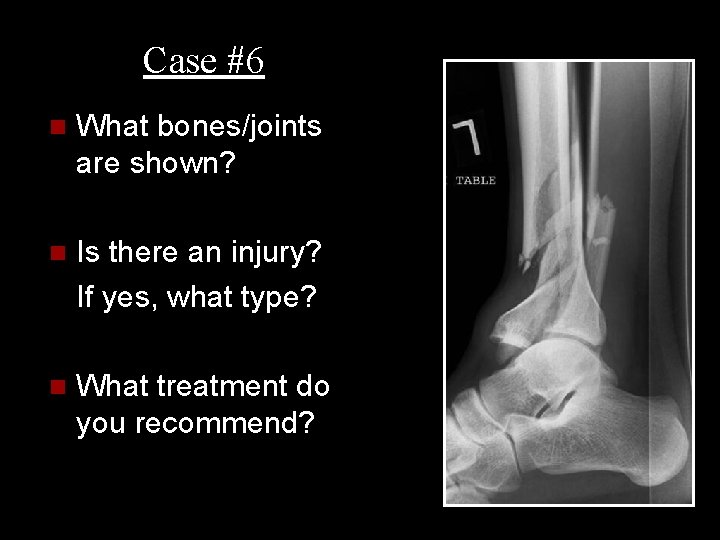 Case #6 n What bones/joints are shown? n Is there an injury? If yes,