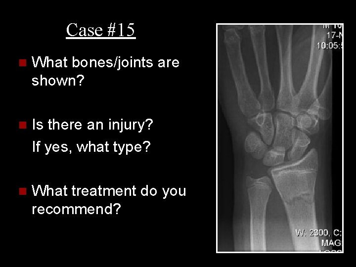 Case #15 n What bones/joints are shown? n Is there an injury? If yes,