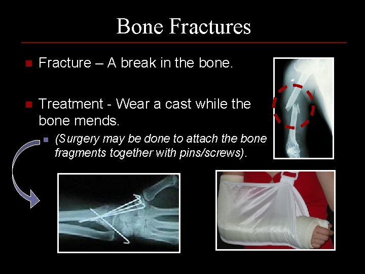 Bone Fractures n Fracture – A break in the bone. n Treatment - Wear