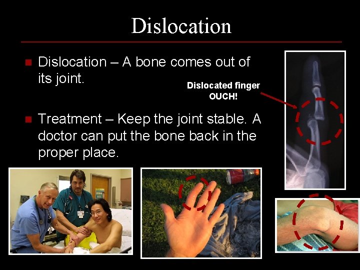 Dislocation n Dislocation – A bone comes out of its joint. Dislocated finger OUCH!