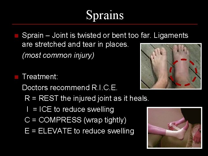 Sprains n Sprain – Joint is twisted or bent too far. Ligaments are stretched