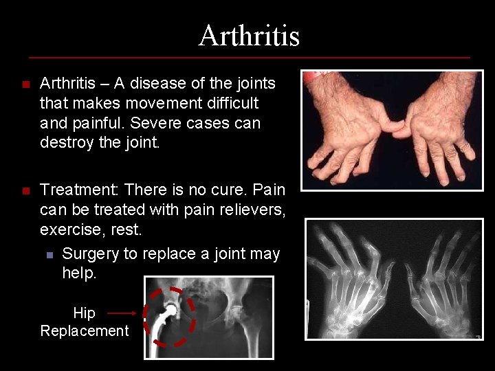 Arthritis n Arthritis – A disease of the joints that makes movement difficult and