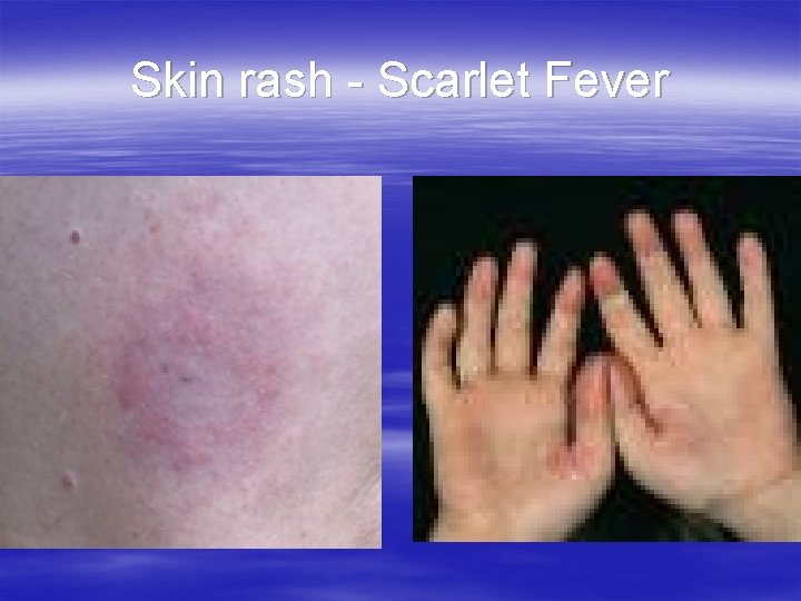 Skin rash - Scarlet Fever 