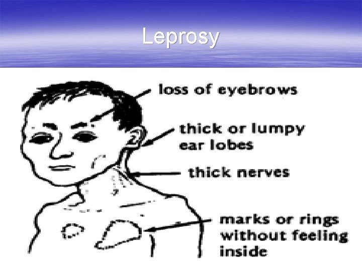 Leprosy 