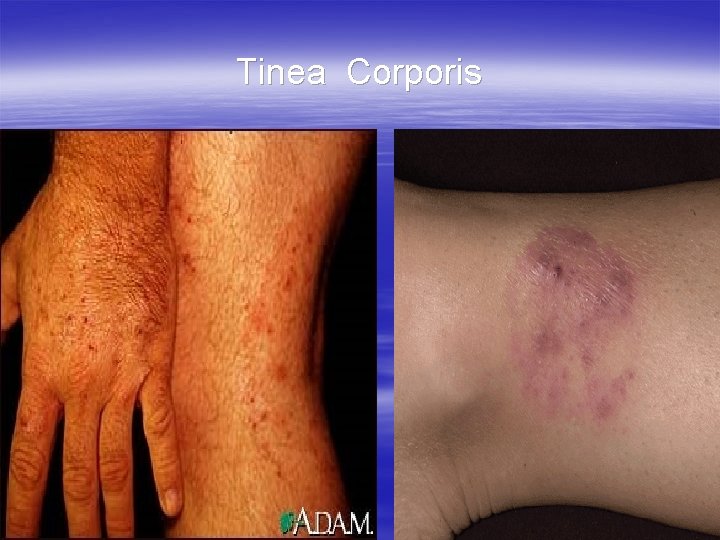Tinea Corporis 
