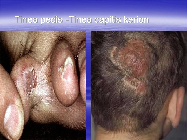Tinea pedis -Tinea capitis kerion 
