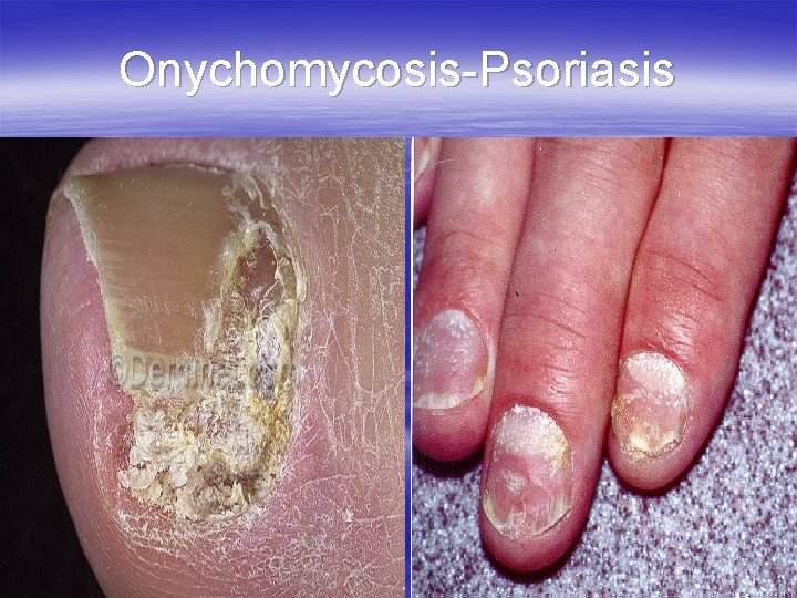 Onychomycosis-Psoriasis 