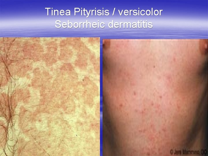 Tinea Pityrisis / versicolor Seborrheic dermatitis 