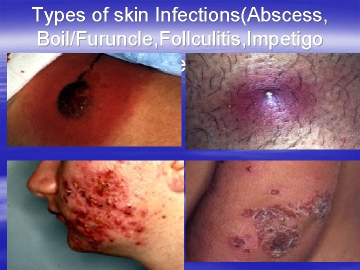 Types of skin Infections(Abscess, Boil/Furuncle, Follculitis, Impetigo 