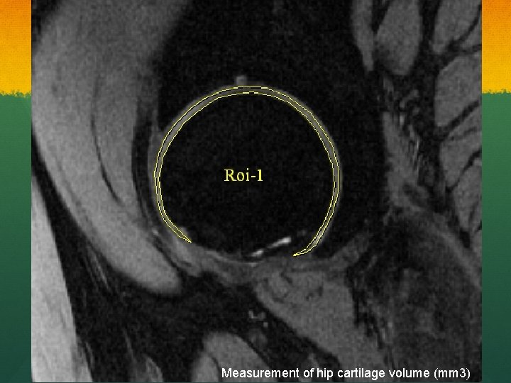 Measurement of hip cartilage volume (mm 3) 