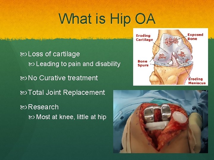 What is Hip OA Loss of cartilage Leading to pain and disability No Curative