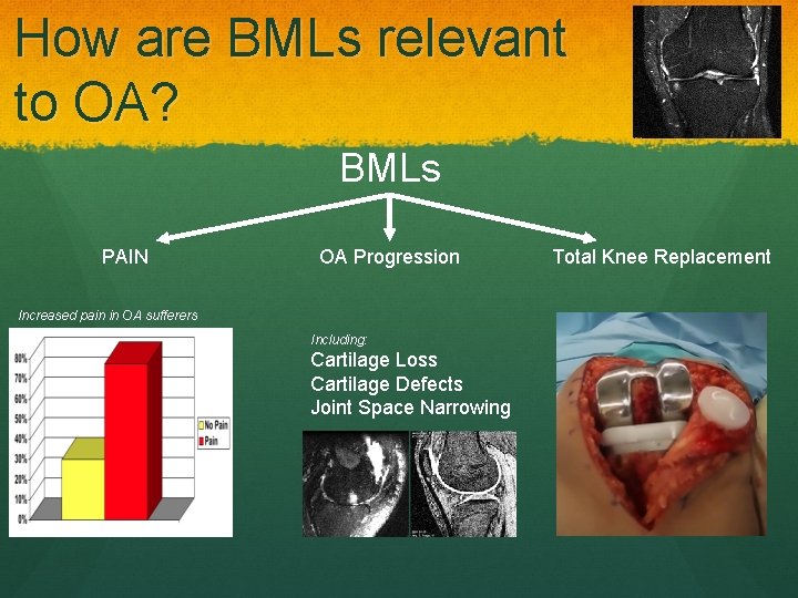 How are BMLs relevant to OA? BMLs PAIN OA Progression Increased pain in OA