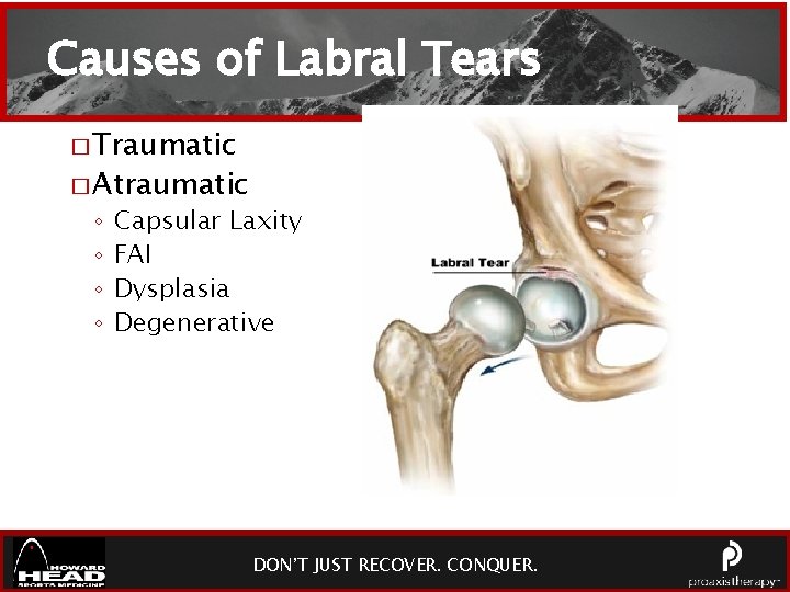 Causes of Labral Tears � Traumatic � Atraumatic ◦ ◦ Capsular Laxity FAI Dysplasia