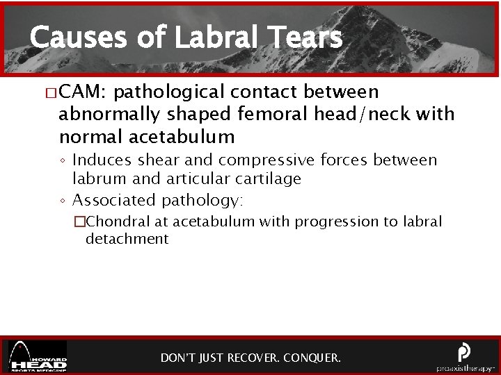 Causes of Labral Tears � CAM: pathological contact between abnormally shaped femoral head/neck with