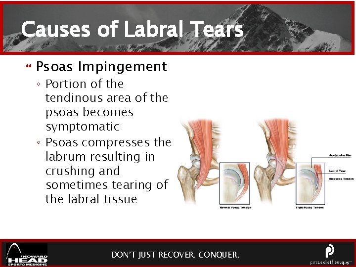 Causes of Labral Tears Psoas Impingement ◦ Portion of the tendinous area of the