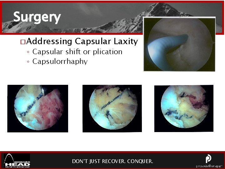 Surgery � Addressing Capsular Laxity ◦ Capsular shift or plication ◦ Capsulorrhaphy DON’T JUST