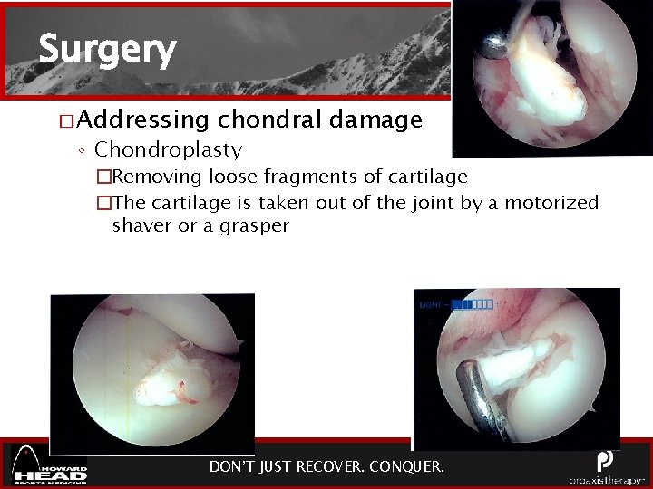 Surgery � Addressing chondral damage ◦ Chondroplasty �Removing loose fragments of cartilage �The cartilage