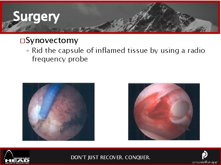 Surgery � Synovectomy ◦ Rid the capsule of inflamed tissue by using a radio